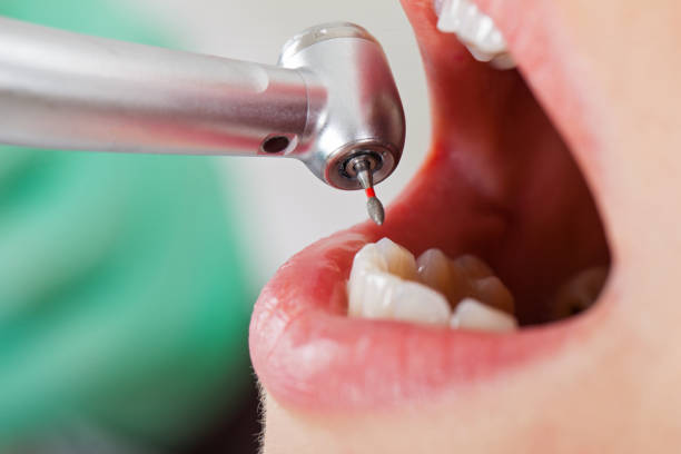 Best Lost Filling or Crown Replacement in Ferguson, MO